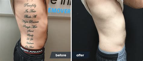 laser tattoo removal timeline|laser tattoo removal fading process.